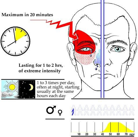 Cluster headache infographic: pain around one eye, lasting 1 to 2 hours, 1 to 3 times per day